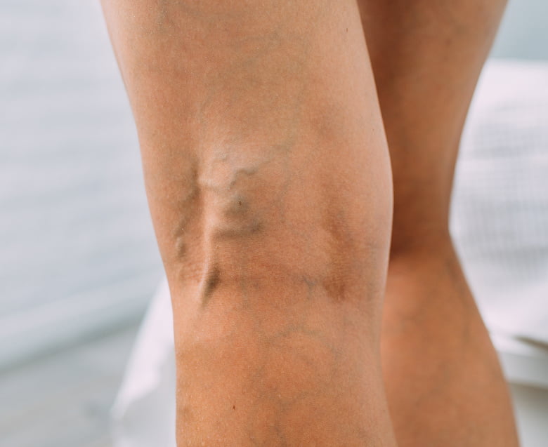 Когда нужно идти к сосудистому хирургу: рекомендации